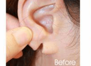 earlobe repair surgery